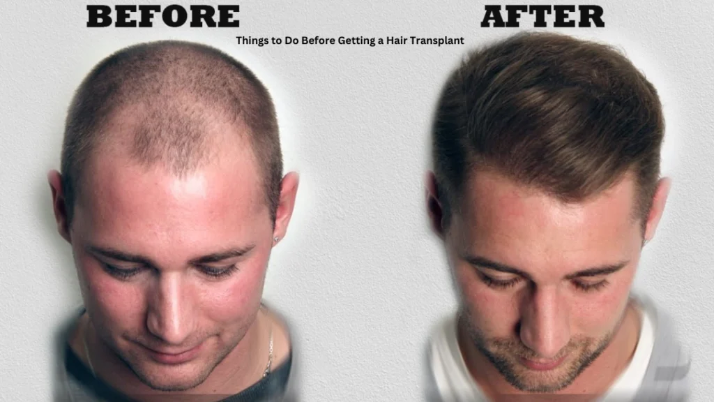 Should You Take After Hair Transplant