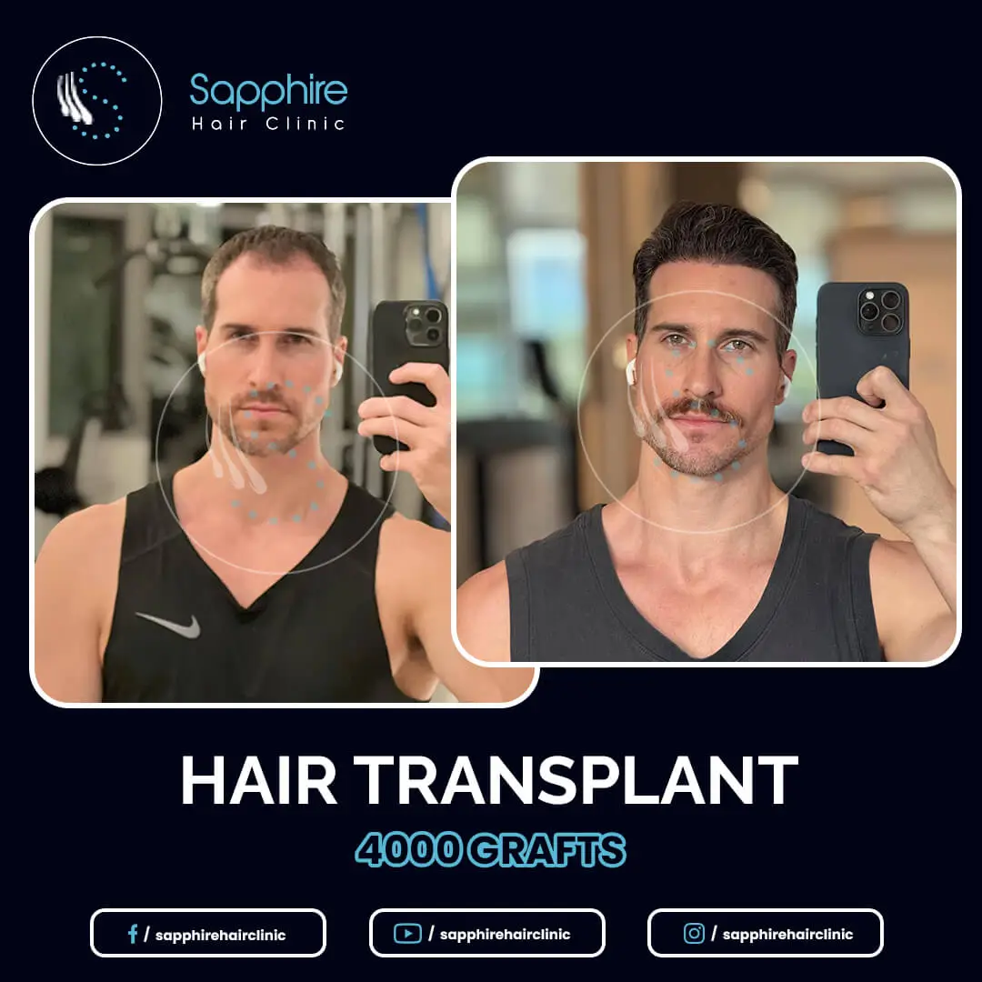 haartransplantation stuttgart