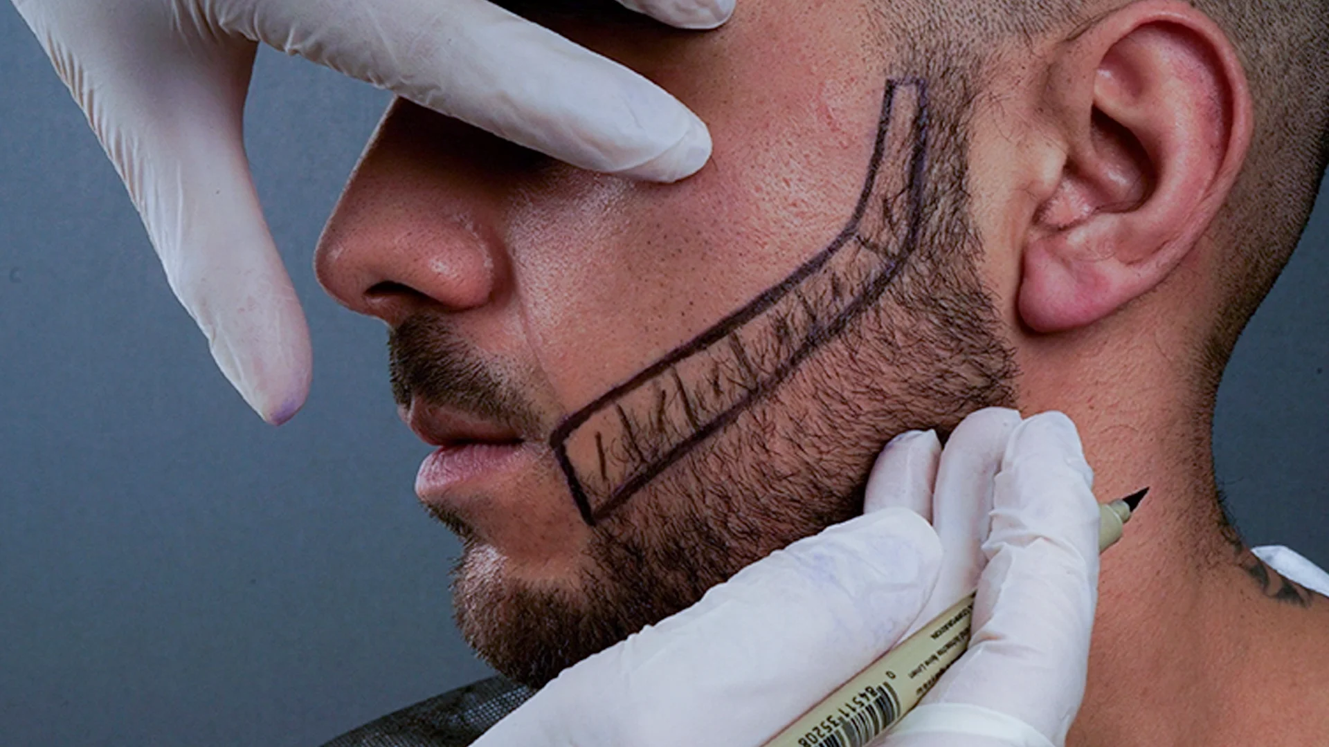 Barttransplantation / Schnurrbarttransplantation