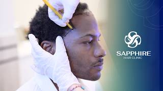 Hair Transplant Experience | Sapphire Hair Clinic
