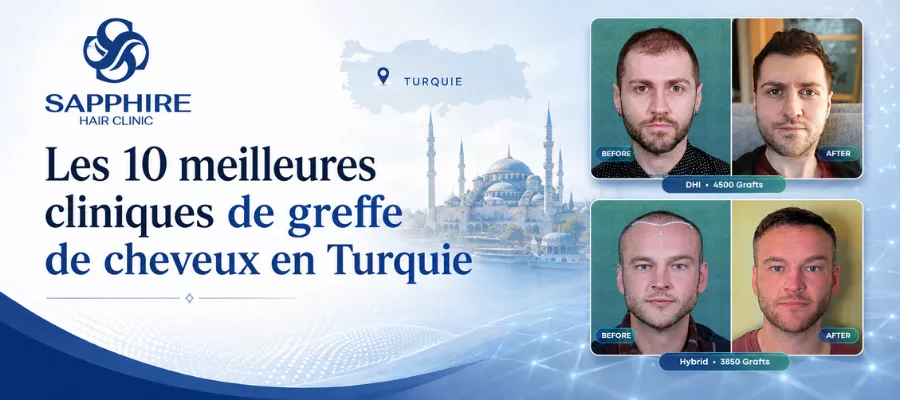 Top 10 Des Cliniques De Greffe De Cheveux En Turquie