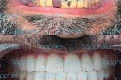 dental_before_after_1
