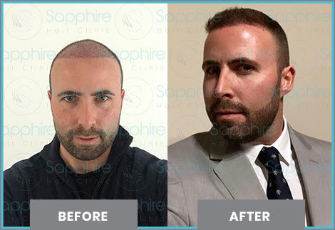 Hair Transplant Procedure | Sapphire Hair Clinic