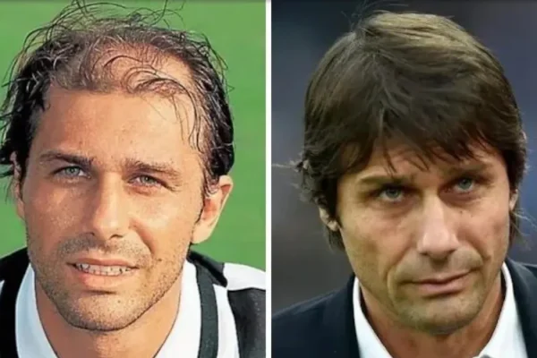 Antonio Conte Hair Transplant