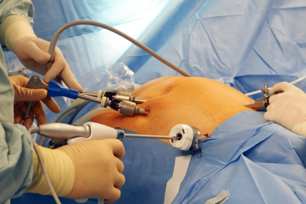 Bariatric Surgery Turkey