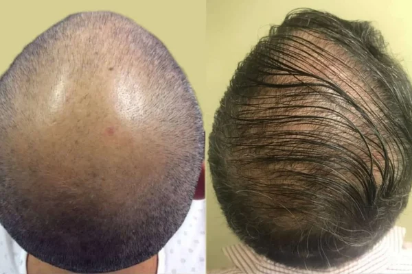 Can Breast Implants Cause Hair Loss?