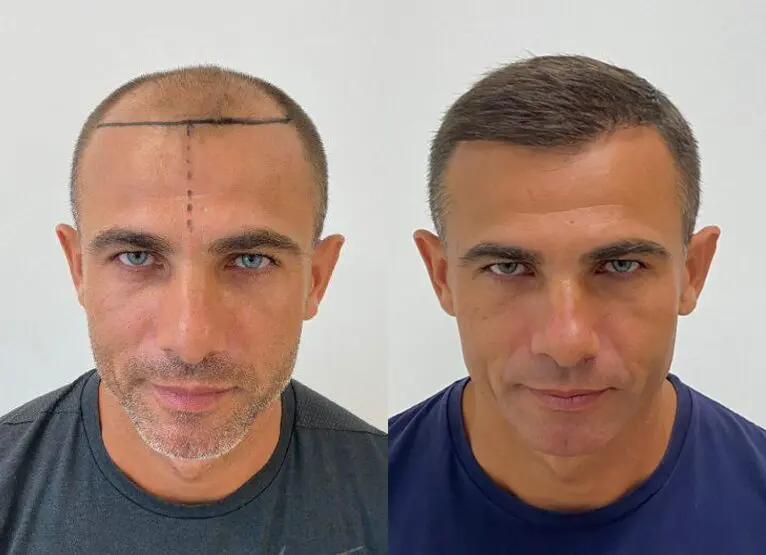 Can i cut my hair after hair transplant?