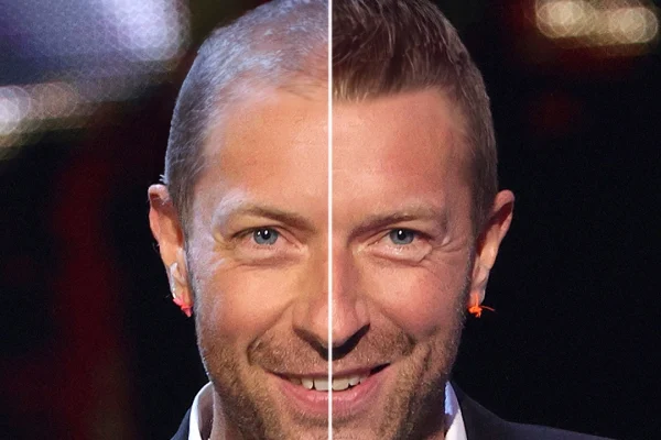 Chris Martin Hair Transplant