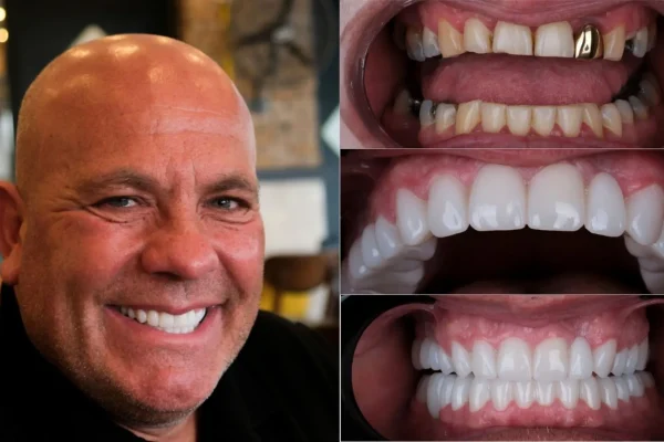 Dental Implants Turkey