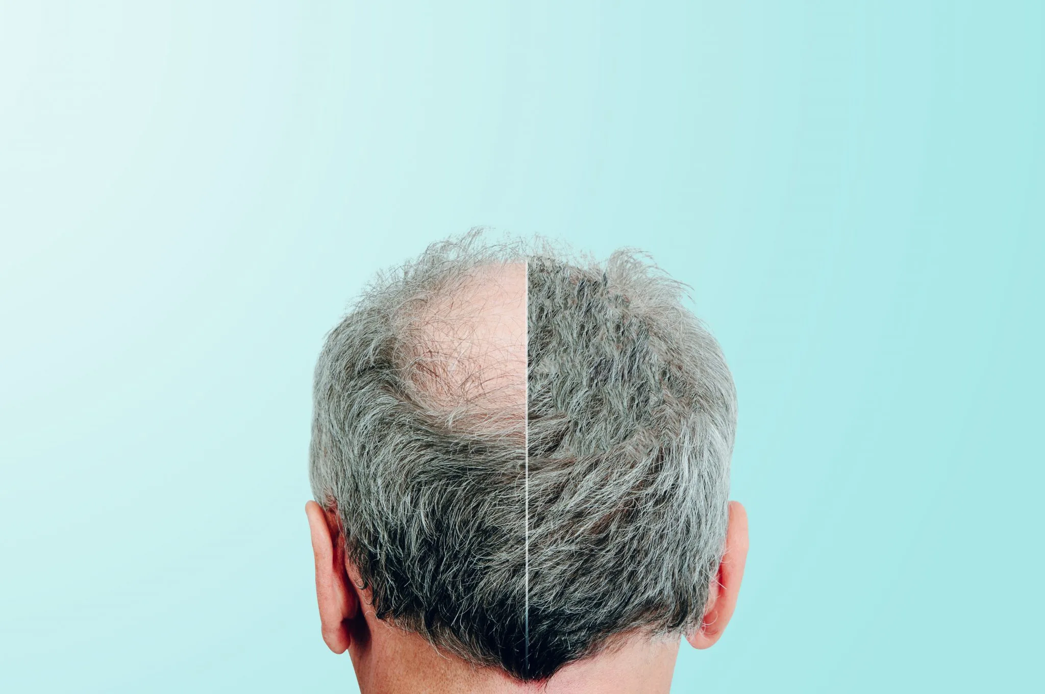 Do I Need a Second Hair Transplantation