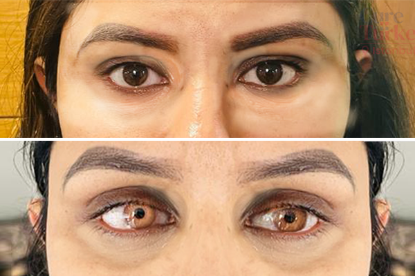 Eye Color Change in Turkey