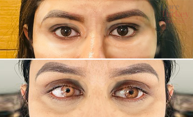 Eye Color Change in Turkey