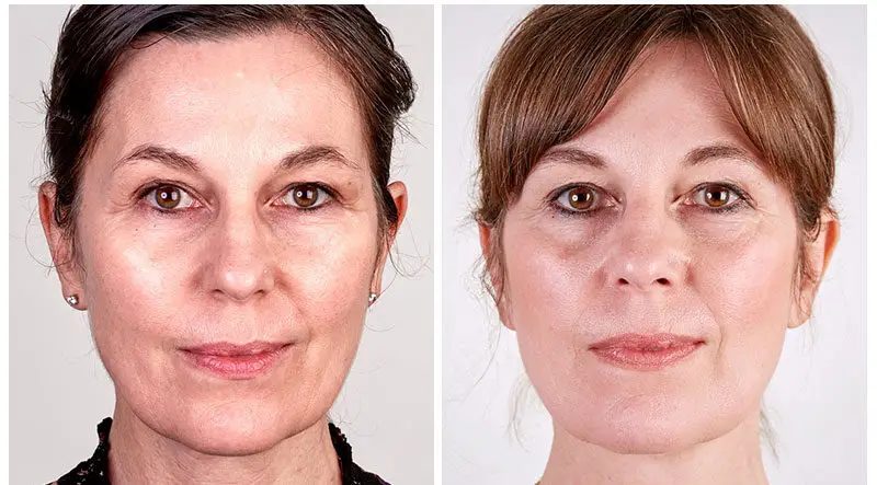 Face Lift Turkey