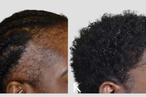 Hair Transplant America