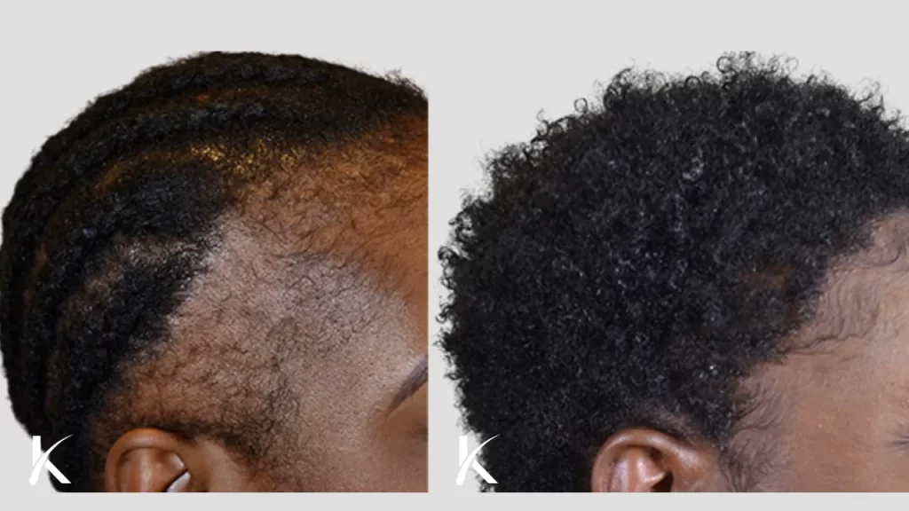 Hair Transplant America