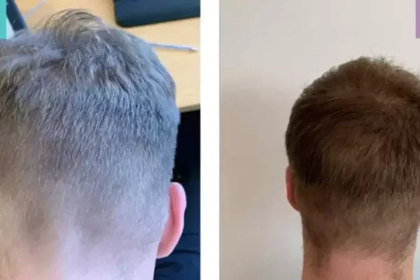 Hair Transplant for Wounded Area