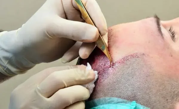 Hair Transplant is a Painful Surgery?