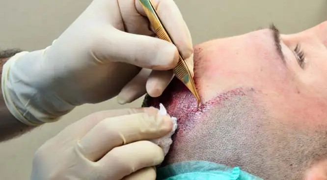 Hair Transplant is a Painful Surgery?