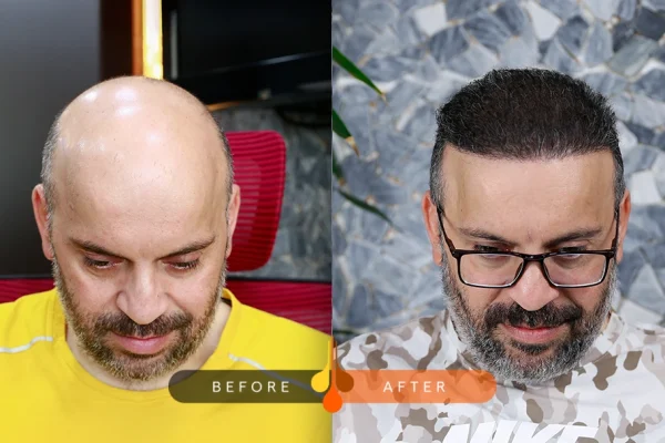 How Hair Transplantation is used in the Treatment of Baldness
