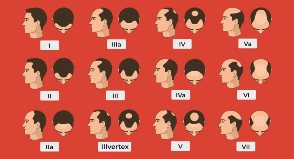 How Serious Is Your Hair Loss According to the Norwood Scale?