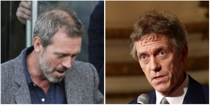 Hugh Laurie Hair Transplant