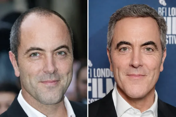 James Nesbitt Hair Transplant