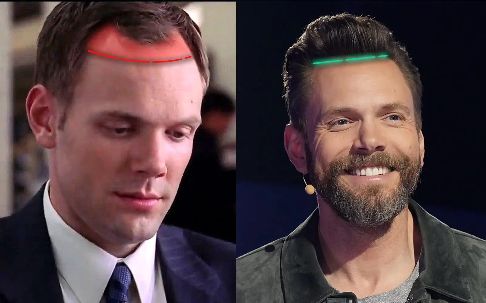 Joel Mchale Hair Restoration