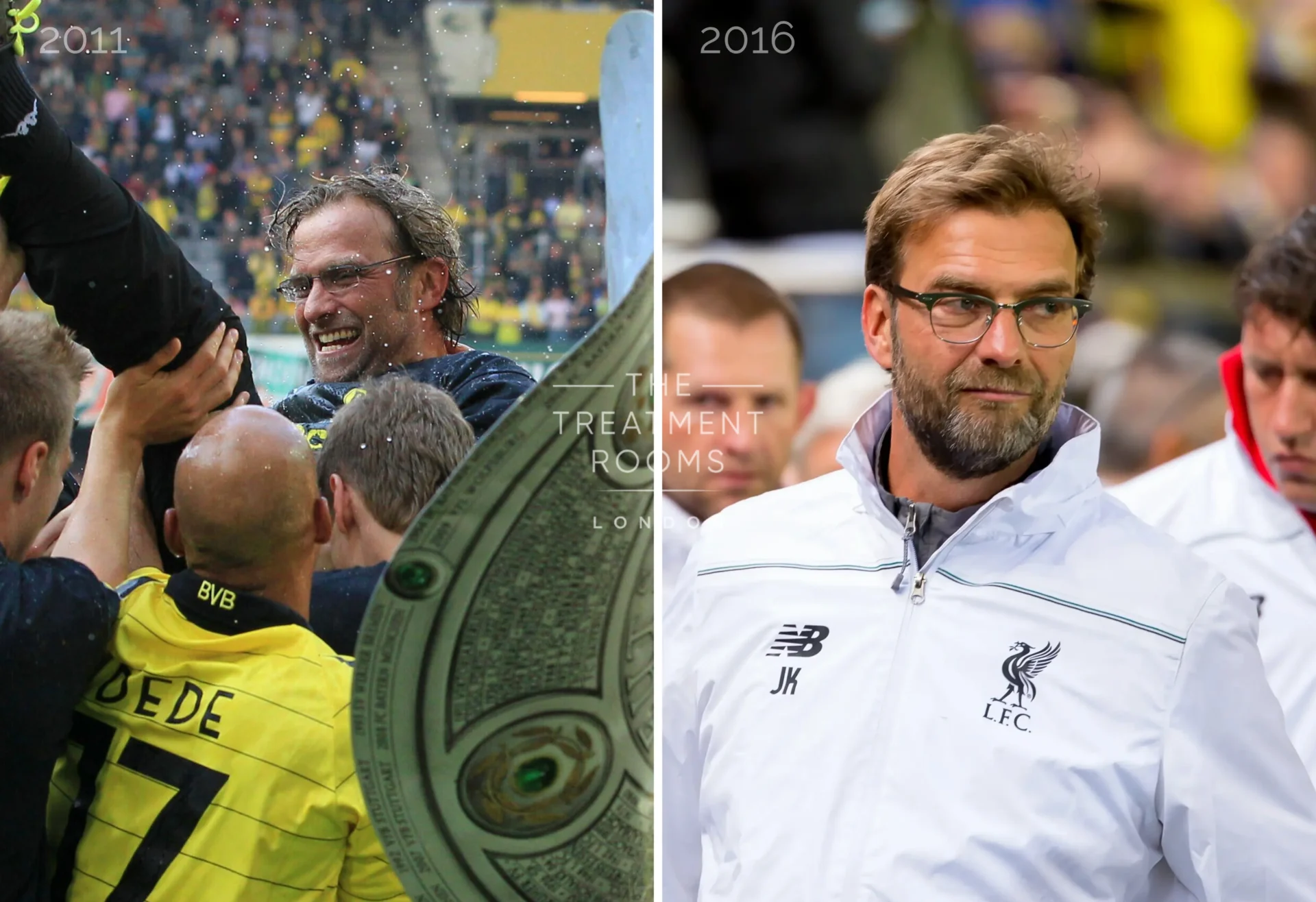 Jürgen Klopp Hair Transplant