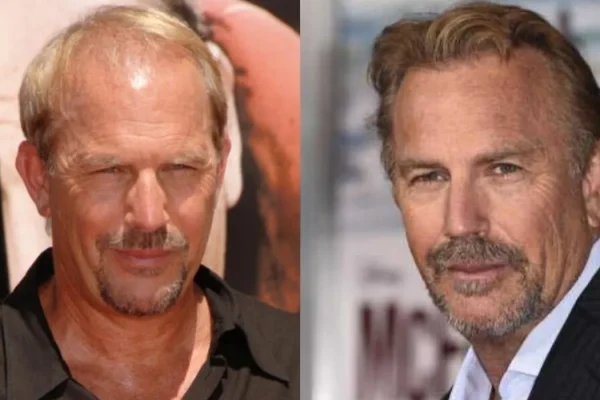 Kevin Costner Hair Transplant