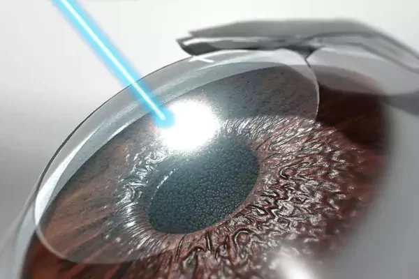 Lasik Turkey
