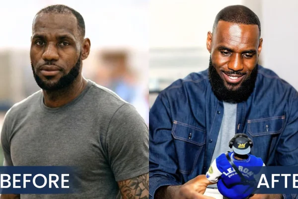 Lebron James Hair Transplant