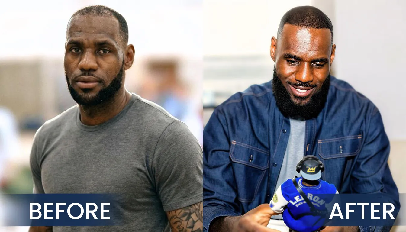Lebron James Hair Transplant