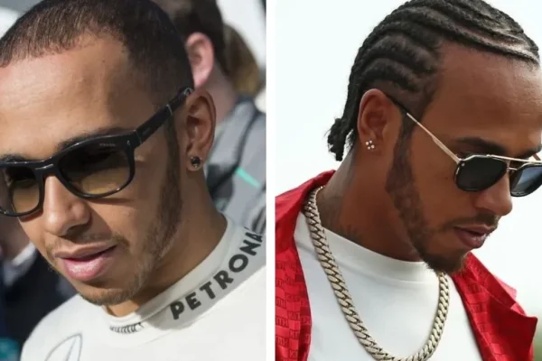 Lewis Hamilton Hair Transplant