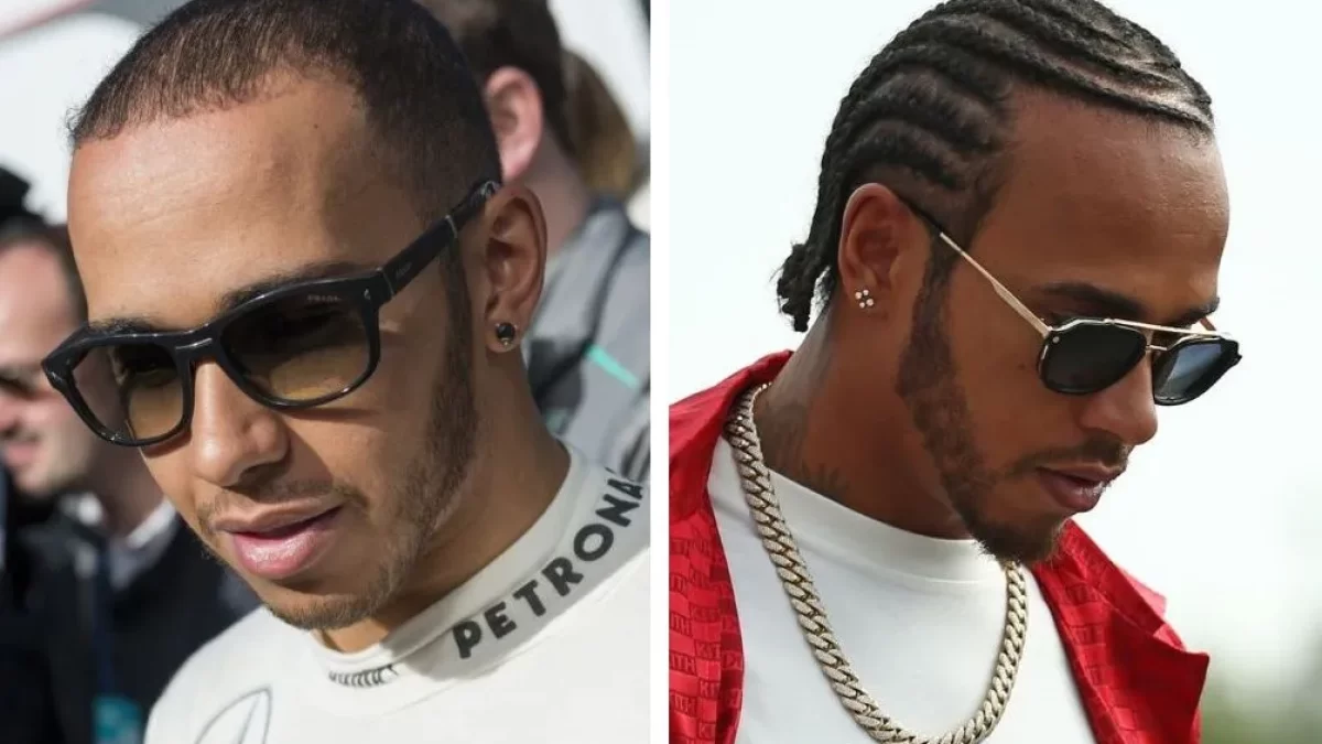Lewis Hamilton Hair Transplant