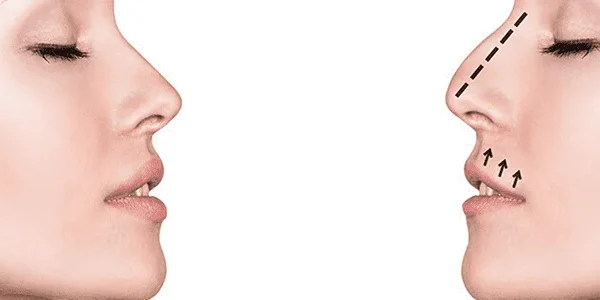 Rhinoplasty