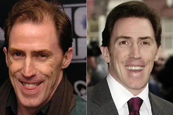 Rob Brydon Hair Transplant