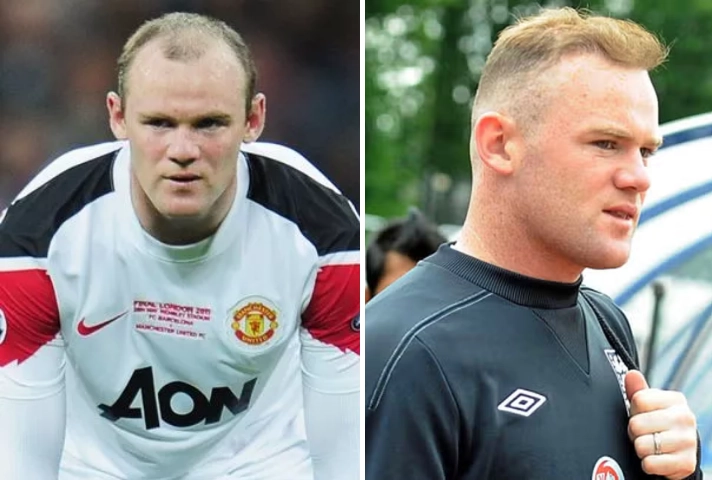 Rooney Hair Transplant