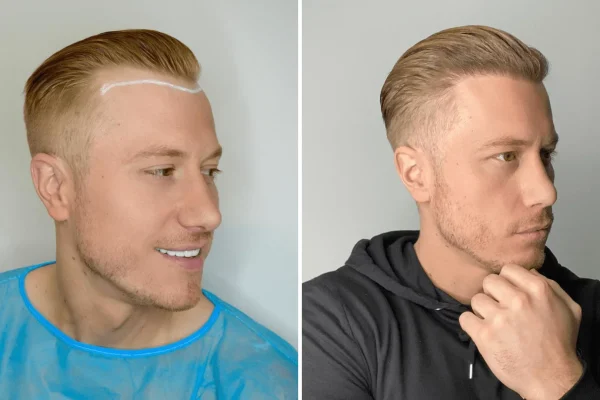 Second Hair Transplant