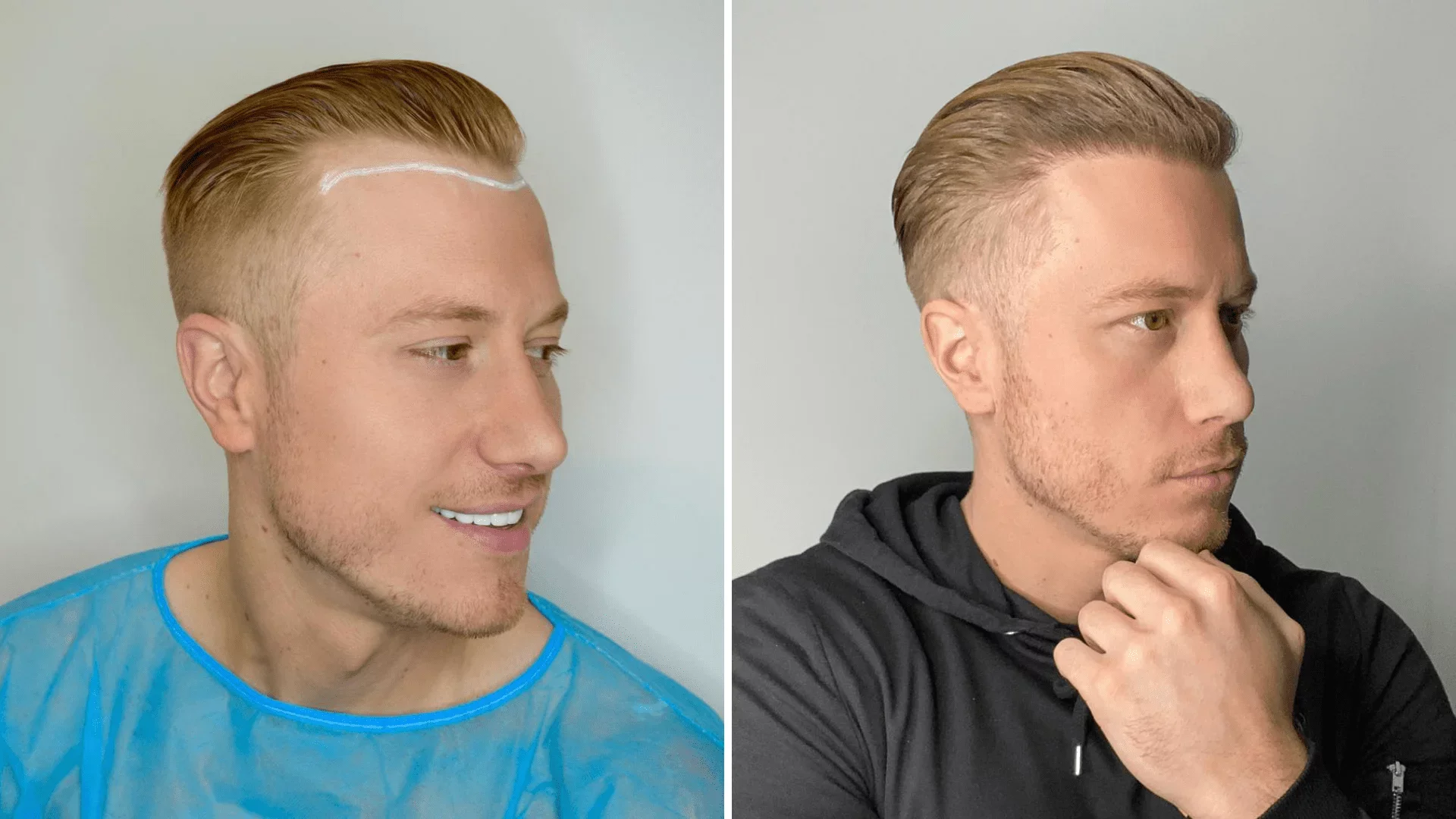 Second Hair Transplant