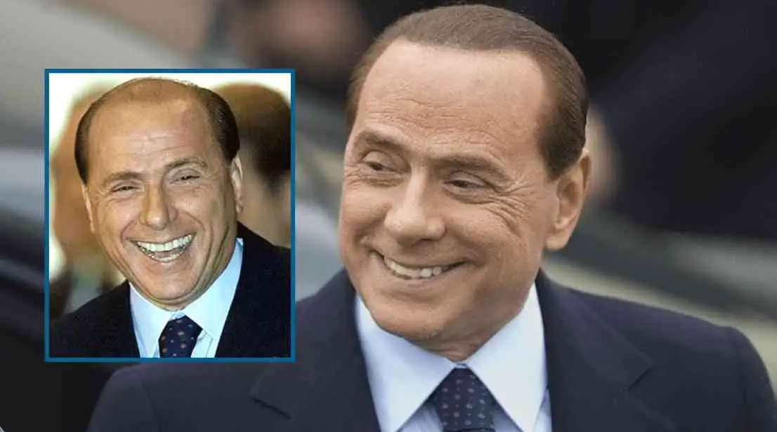 Silvio Berlusconi Hair Transplantation