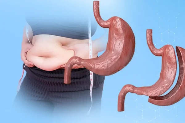 Sleeve Gastrectomy Turkey