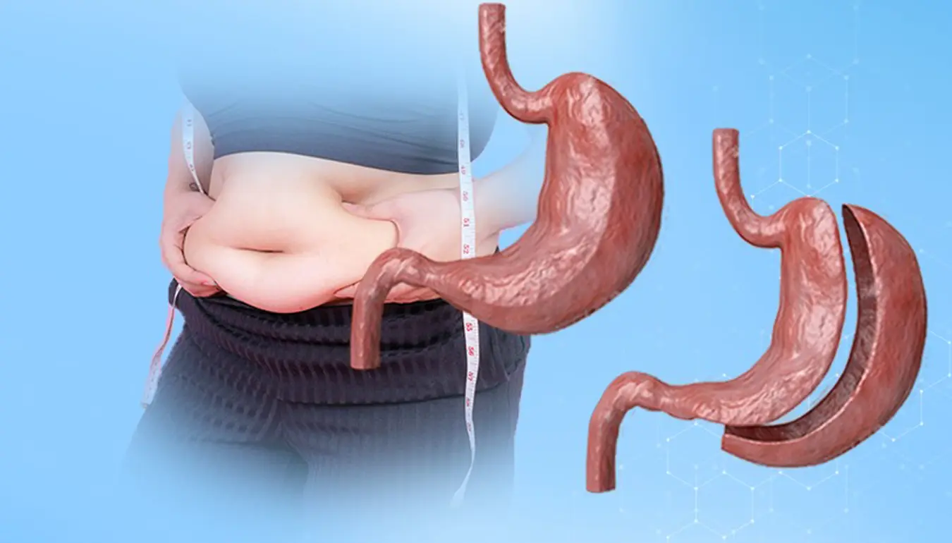 Sleeve Gastrectomy Turkey