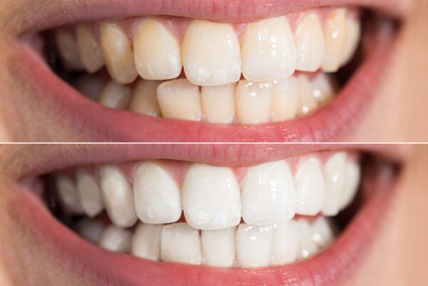Teeth Whitening Turkey – Istanbul