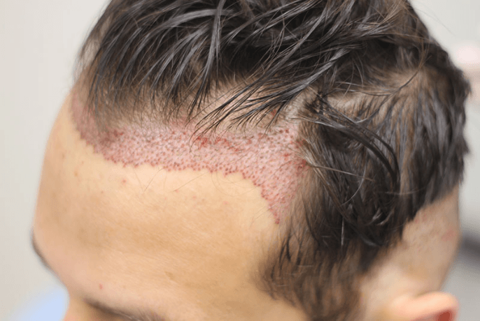 Hair Transplant Without Shaving | Sapphire Hair Clinic