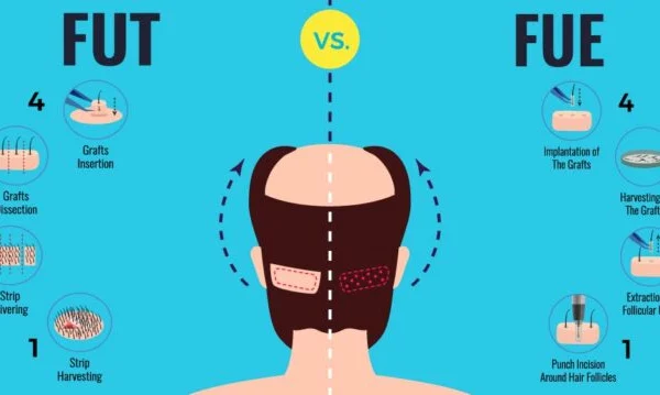 What is the Difference Between DHI and FUE?