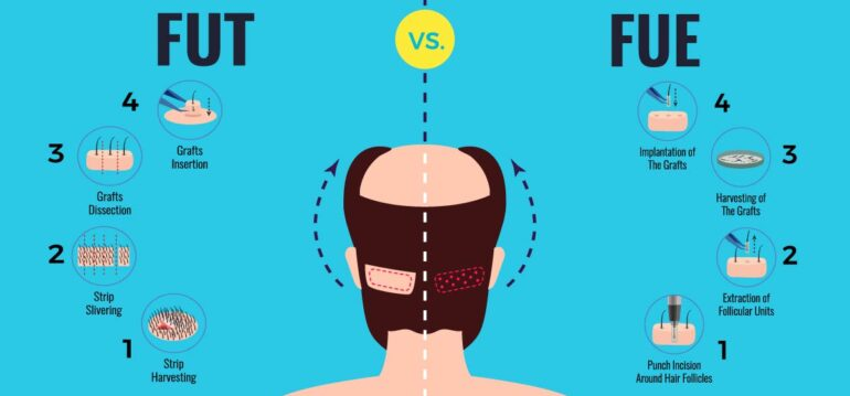 What is the Difference Between DHI and FUE?