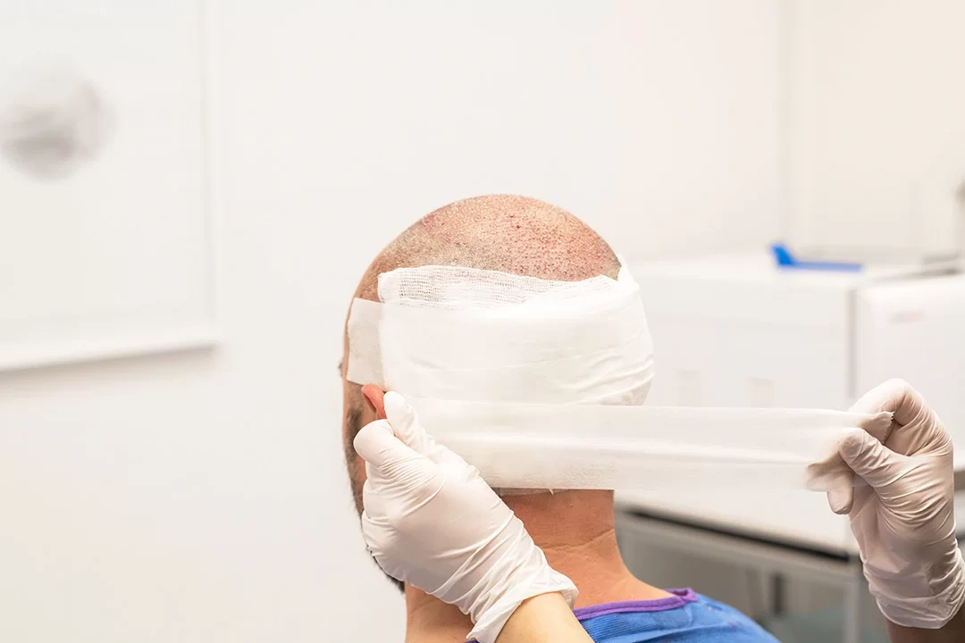 When Should the Bandage Be Removed After Hair Transplant?