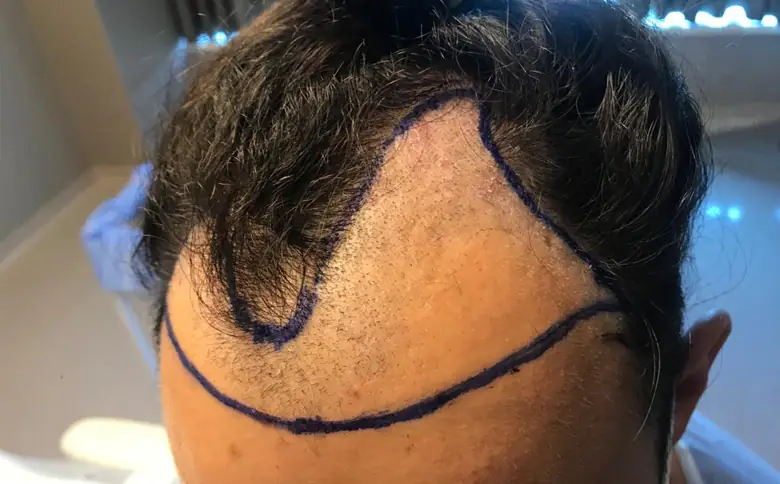 Will I Lose My Hair After a Hair Transplantation?