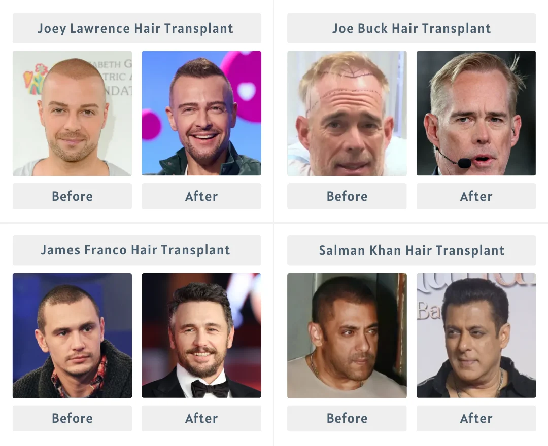 Celebrity Hair Transplant