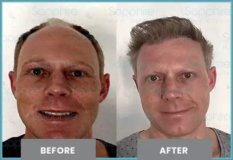 FUT hair transplant in Turkey